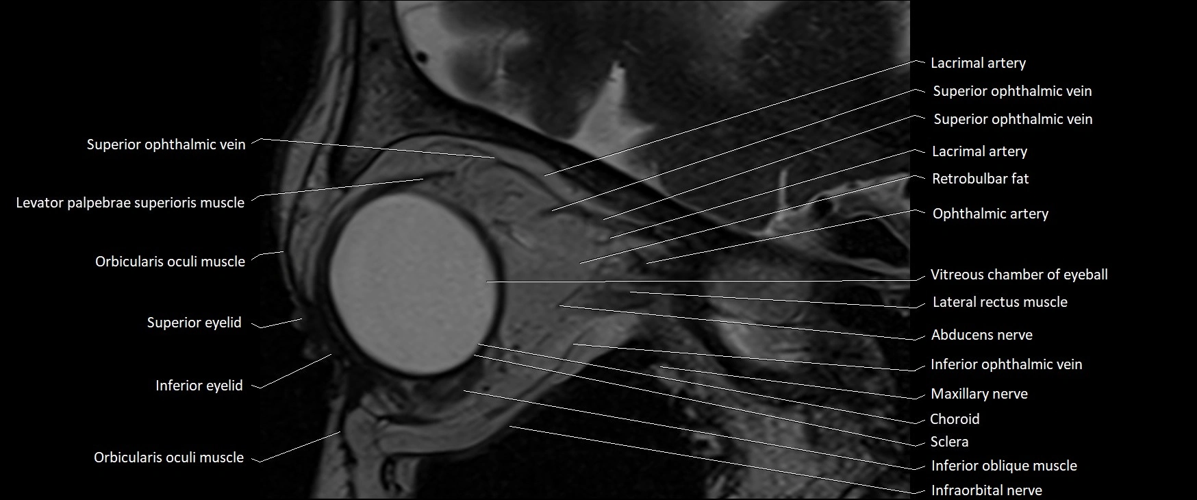 MRI Orbit sagittal cross sectional anatomy 3T image 12.webp